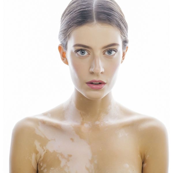 Vitiligo: How do I know which treatment is best for me?