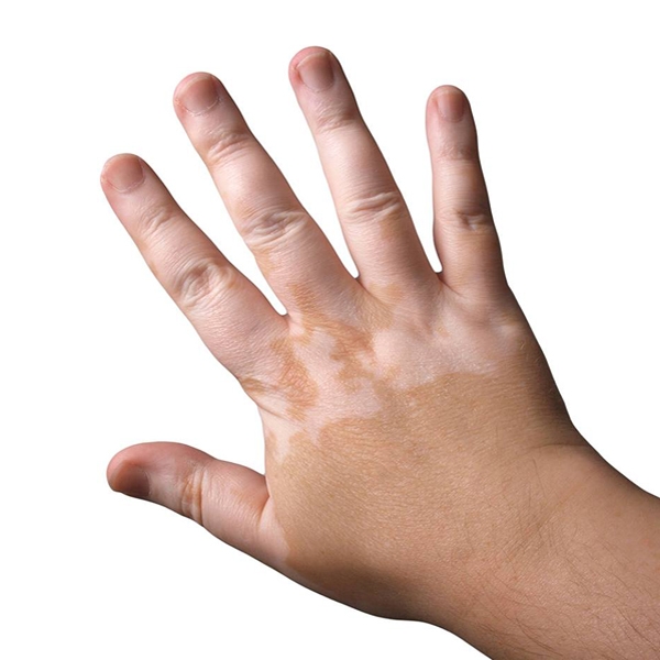 Diagnosing and treating vitiligo in childhood