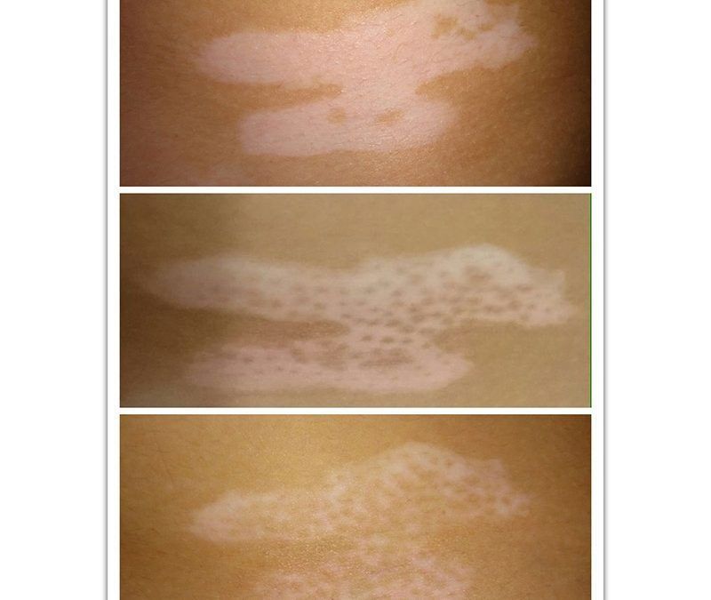 Great results in vitiligo treatment