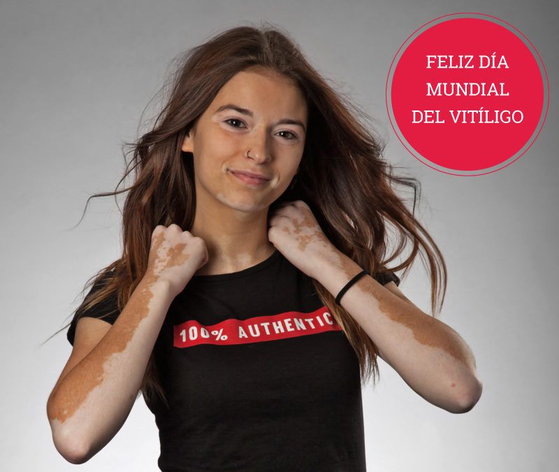 Día Mundial del Vitíligo