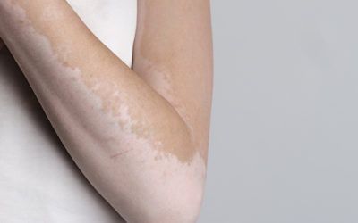 How can we get rid of white patches on the skin?