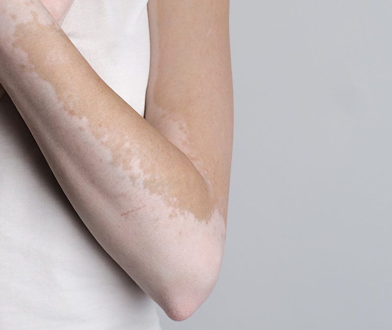 ¿Cómo eliminar las manchas blancas de la piel?