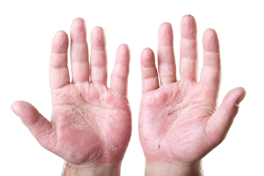 Últimos avances en el tratamiento de la psoriasis